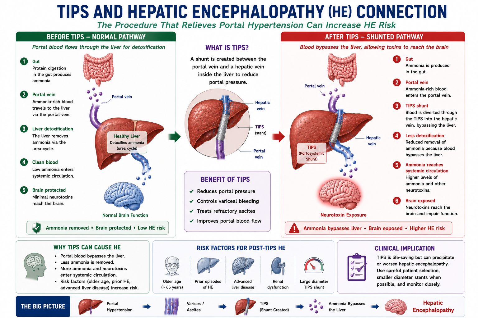 Diagram showing how TIPS creates a direct portal-to-systemic shunt that bypasses liver detoxification allowing ammonia to reach the brain in higher concentrations and increasing the risk of hepatic encephalopathy